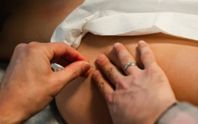 Dry Needling for Hip Flexor Pain