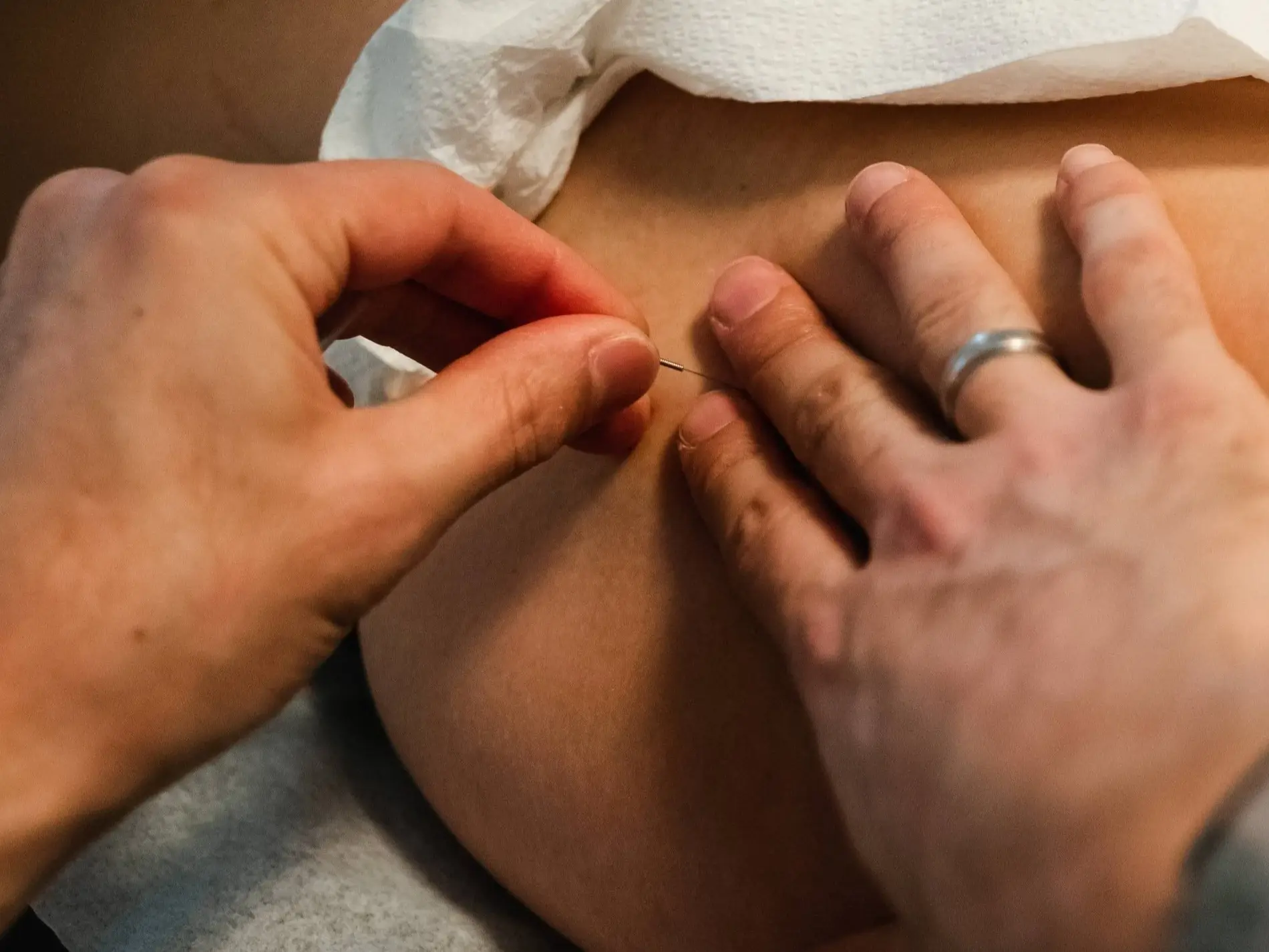Dry Needling for Hip Flexor Pain Dry Needling for Hip Flexor Pain