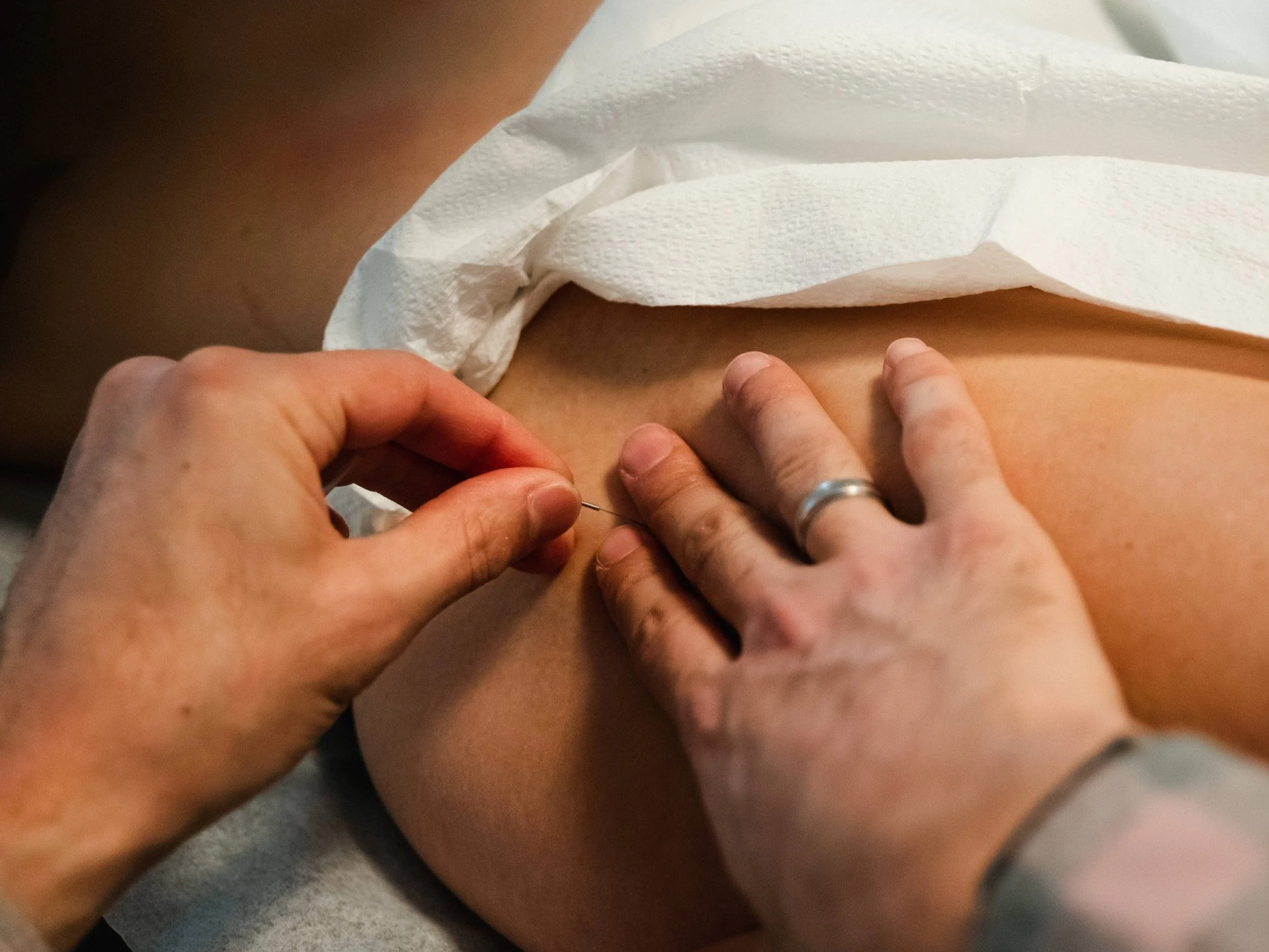 Dry Needling for Hip Flexor Pain